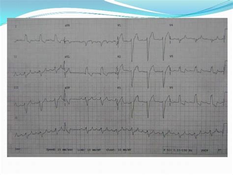 ECG: Trifascicular Block