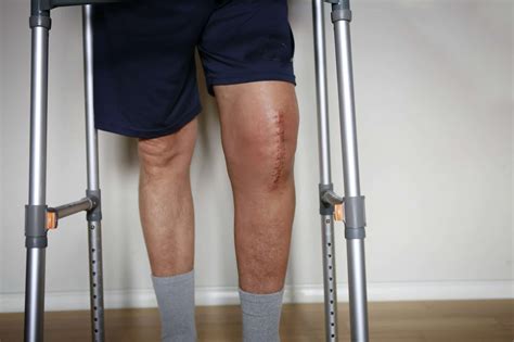 KNEE REPLACEMENT SURGERY AND SSD BENEFITS