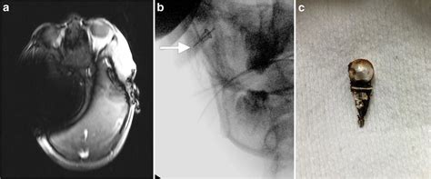 Susceptibility artifact during an intraoperative MRI performed to ...