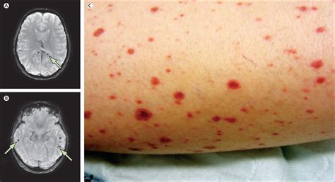 Disseminated varicella zoster virus encephalitis - The Lancet