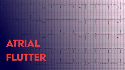 Atrial Flutter - EKG (ECG) Interpretation - YouTube