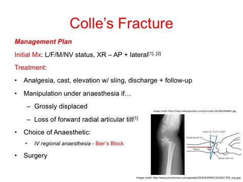 Colles Fracture Treatment