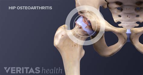 Osteoarthritis Complete Treatment Guide