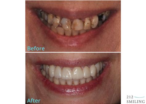 Female All Ceramic Crowns Before and After - 212 Smiling