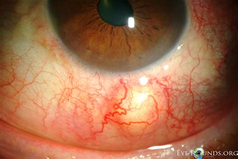 Atlas Entry - Nodular anterior scleritis