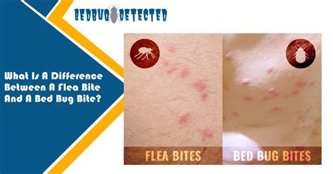 bed bugs vs fleas | Difference Between A Flea Bite And A Bed Bug Bite