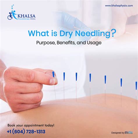 What is Dry Needling? - Purpose, Benefits, and Usage