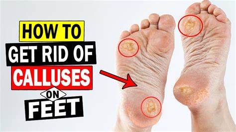 How to Remove Calluses on Feet at Home || Home Remedies for Calluses on ...