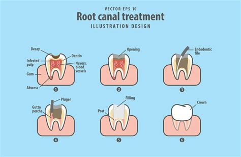 Root Canal or Extraction: Which Choice is Best? | Cedar Spring Dentistry