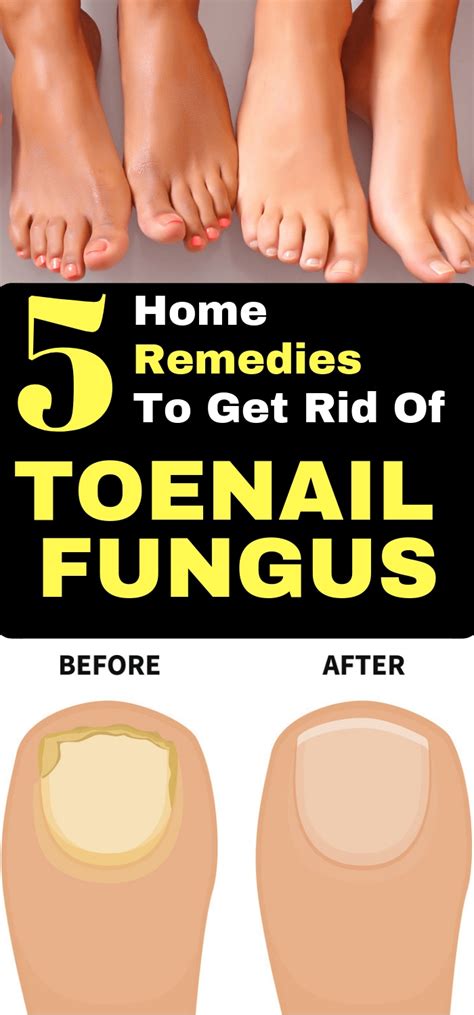 Daily Health Advisor : 5 Home Remedies for Toenail Fungus