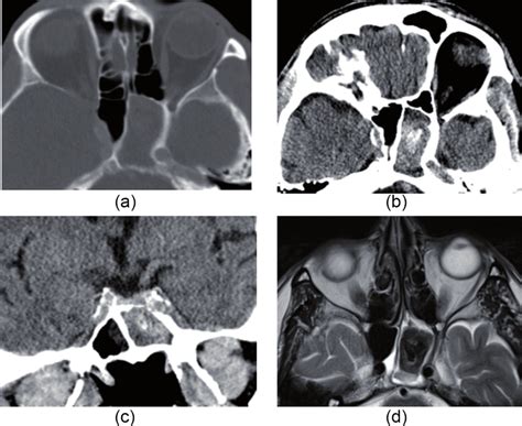 A 53-year-old man, who presented with diplopia. (a) Axial CT with bone ...