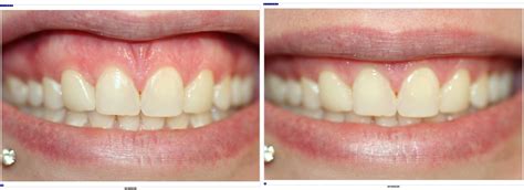 Composite Veneers vs Porcelain Veneers (Before and After) – McFarlane Dental