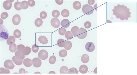 Echinocytes (Burr Cells) • The Blood Project