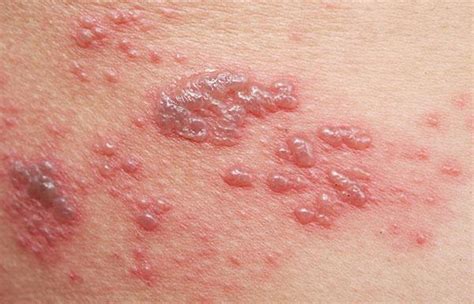 Herpes Zoster (Shingles) | Hartig Drug Stores