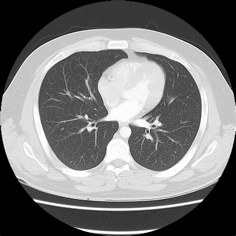 Normal CT chest | Image | Radiopaedia.org