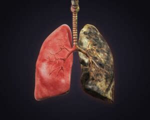 What Is Smoker Lung? Symptoms, Treatment, & Causes