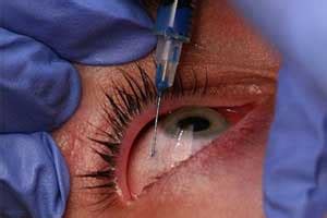 Avastin Eye Injection : Side Effects Of Avastin Injections In The Eye - creditosgrazy