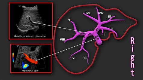 Portal Vein Doppler – Sonographic Tendencies