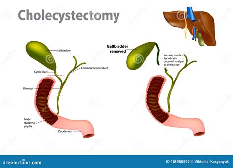 Chirurgie D'enlèvement De La Vessie Galloise Illustration de Vecteur ...