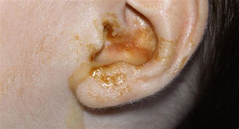 Ear Infection In Infants