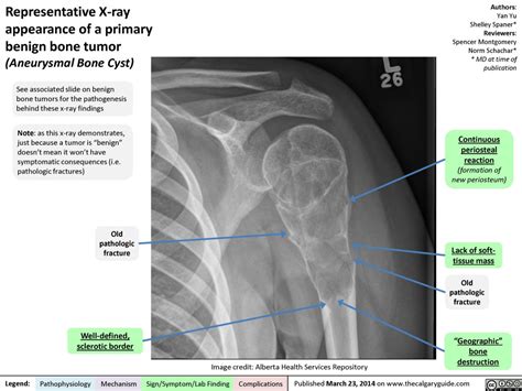 Representative X-ray appearance of a primary benign bone tumor | Calgary Guide