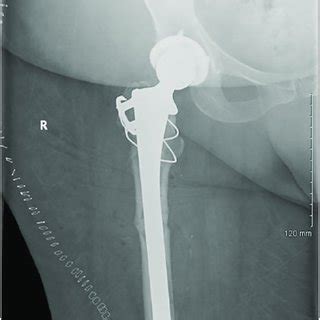 Anteroposterior x-ray of right hip with periprosthetic subtrochanteric ...