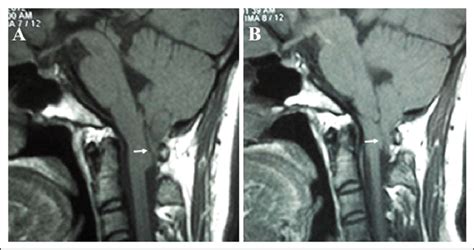 —Sagittal MRI image shows the caudal displacement of cerebellar tonsils... | Download Scientific ...