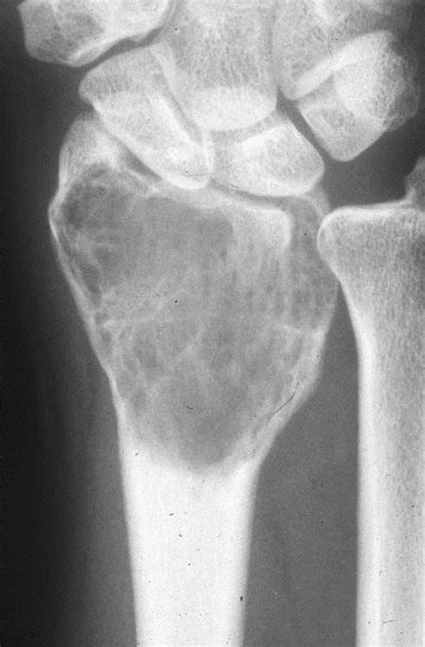 Giant Cell Tumor - Pathology - Orthobullets