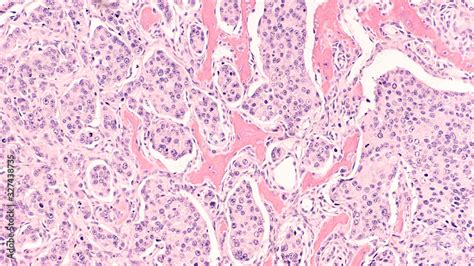 Metastatic prostate cancer: Photomicrograph of bone biopsy showing metastasis of prostatic ...