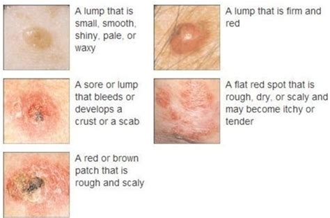 Early Skin Cancer Symptoms