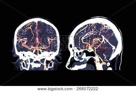 Ct Angiography Brain Image & Photo (Free Trial) | Bigstock