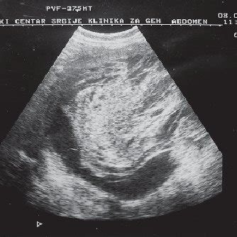 Ultrasound showing a giant cyst within the right lobe of the liver ...