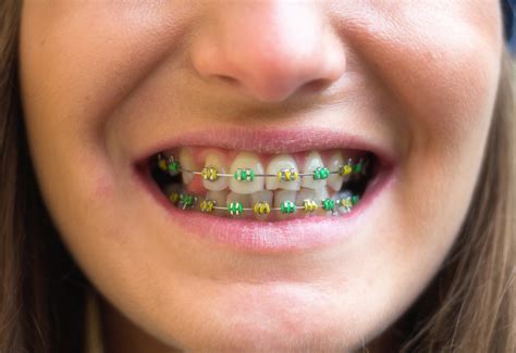 The Best Braces Color Combinations To Try Next | Thomas Orthodontics