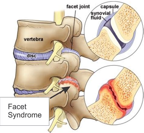 Penyakit Facet Joint Adalah Penyebab Lain Nyeri pada Leher dan Pinggang ...