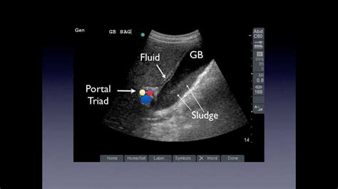 Portal Triad Ultrasound