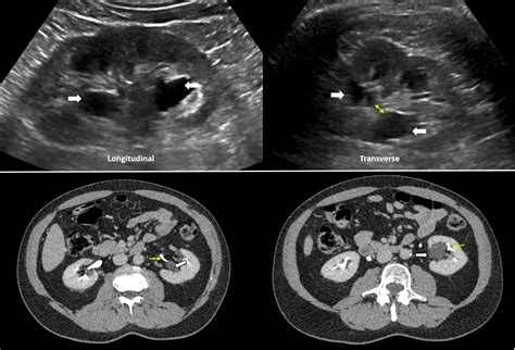 Normal Kidney Ultrasound