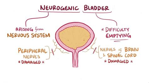 Video: Neurogenic bladder