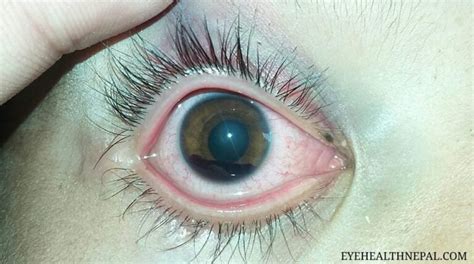 What is Hyphema? How to Treat Hyphema and its Complications - Eye Health Nepal