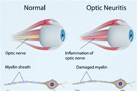 Optic Neuritis: Symptoms, Causes, and Treatments