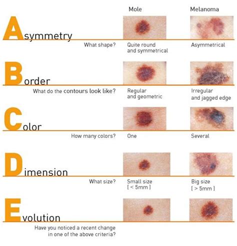 Superficial Spreading Melanoma Vs Lentigo Maligna