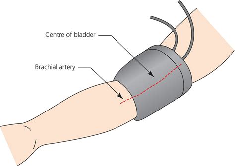 Blood pressure measurement | Thoracic Key