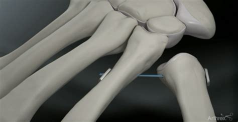 Basal Thumb Arthritis: Symptoms & Treatment | The Hand & Wrist Institute (2022)