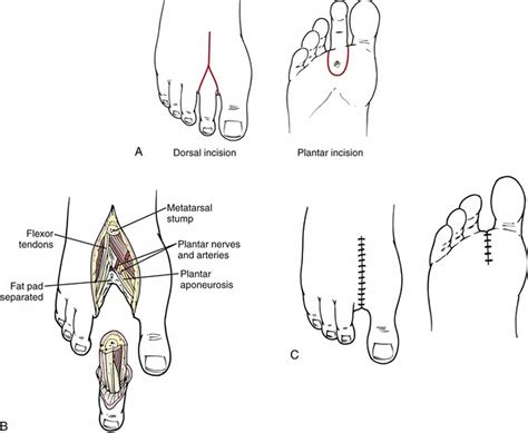 Amputation causes, types of amputation and amputation complications