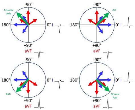 Heart left axis deviation causes, symptoms & treatment