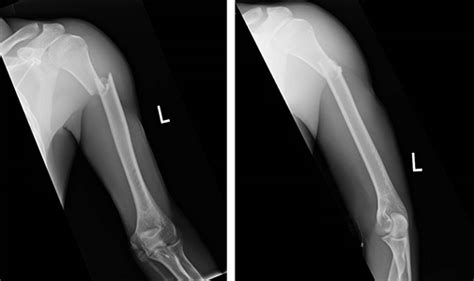 Humeral Shaft Fracture (Broken Upper Arm Bone) | Orthopaedic Trauma ...