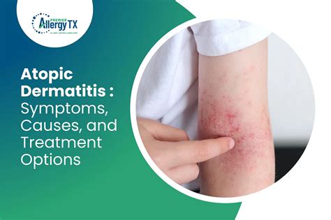 Understanding Atopic Dermatitis: Symptoms and Treatments | by PremierAllergyTx | Sep, 2023 | Medium