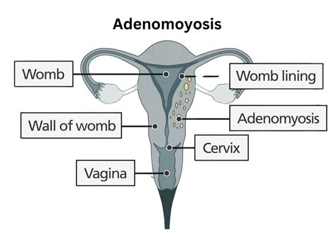 What is Adenomyosis? — THE ADENO GANG