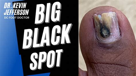 Big Black Spot: Unusual Fungal Toenail - YouTube