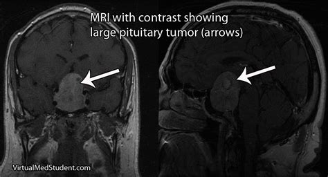 VirtualMedStudent.com || Pituitary Adenomas