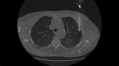 Percutaneous CT-guided Lung Biopsy Procedure Technique - YouTube